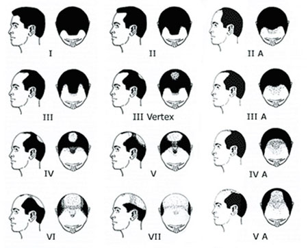 Hair Loss Types Hair Doctor Network